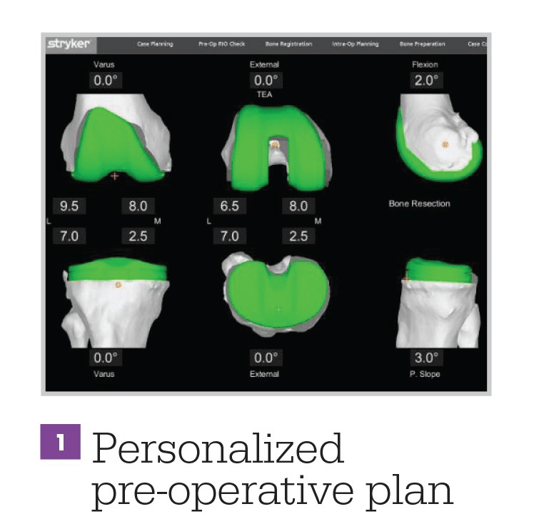 MAKO Robotic Total Knee Replacement