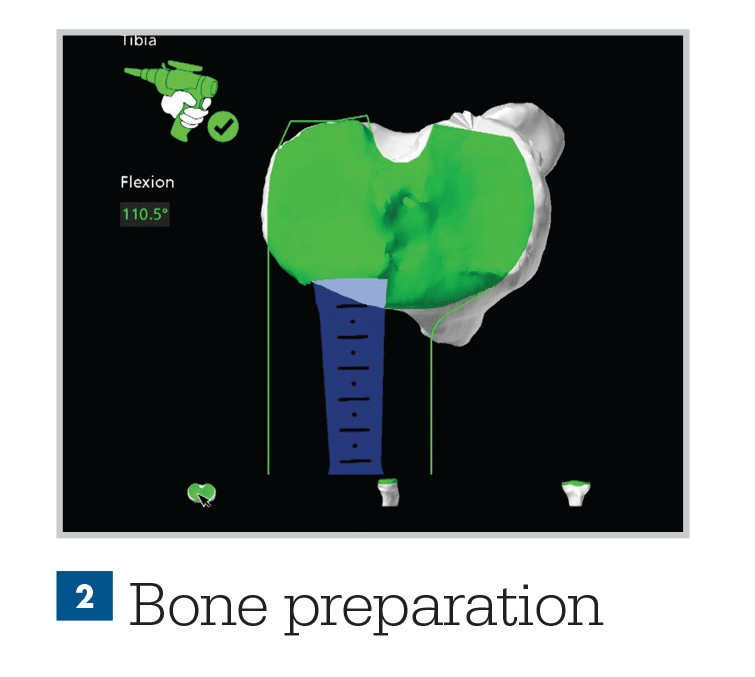 MAKO Robotic Total Knee Replacement