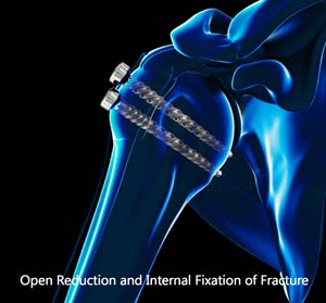 Open Reduction and Internal Fixation of Proximal Humerus Fracture 