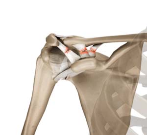 Acromioclavicular Joint (AC joint) Dislocation