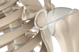 Arthroscopic Bankart Repair