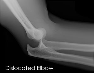  Elbow Pain