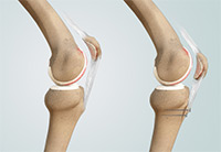 Distal Realignment Procedures