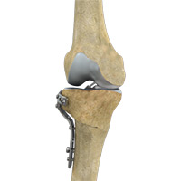 High Tibial Osteotomy