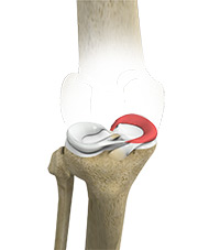 Medial Meniscus Syndrome