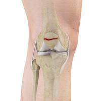 Patella Fracture