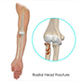 Elbow Fractures