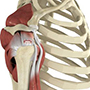 Rotator Cuff Tear