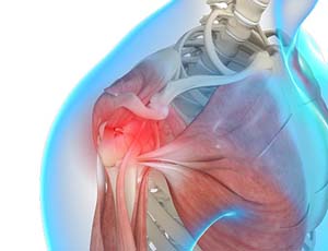 Osteochondritis Dissecans