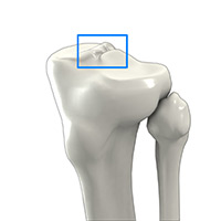 Tibial Eminence Spine Avulsions