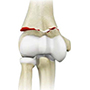 Elbow Fractures