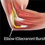 Elbow (Olecranon) Bursitis