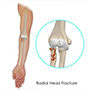 Radial Head Fractures of the Elbow