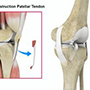 ACL Reconstruction