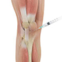 Cortisone Injection