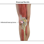 Bursitis