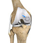 Osteochondritis Dissecans