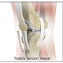 Patella Tendon Repair