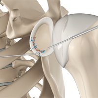 Arthroscopic Bankart Repair