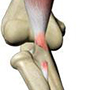 Biceps Tendon Rupture