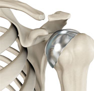 Partial Shoulder Replacement