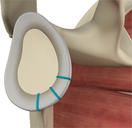 Shoulder Labrum Reconstruction