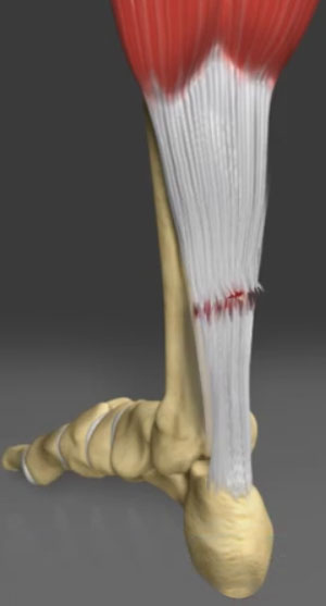 Achilles Tendon Tear Repair