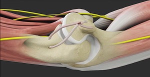  UCL Reconstruction